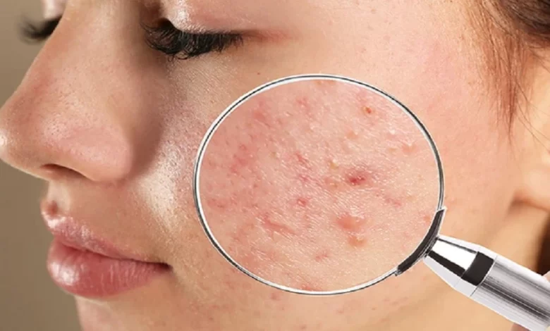 Skin Care Tips To keep pimples away from the skin include these five things in your diet